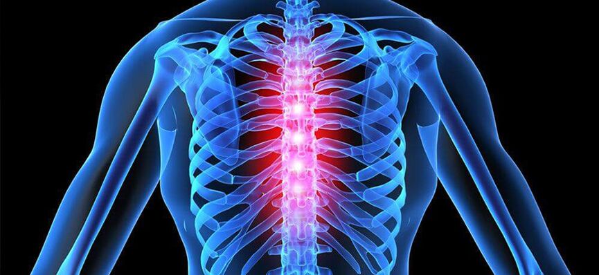 Poslabšanje osteohondroze prsne hrbtenice