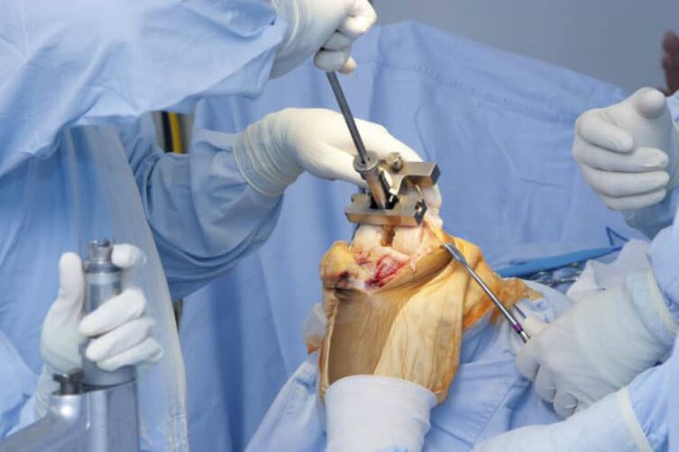 operacija artroze kolena