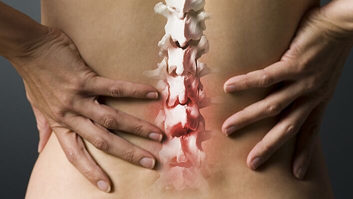 osteokondritis hrbtenice