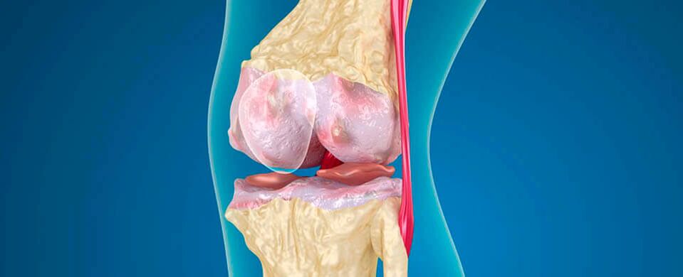 artroza kolena kot vzrok bolečine