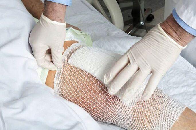 Terapevtski obkladek za artrozo kolenskega sklepa