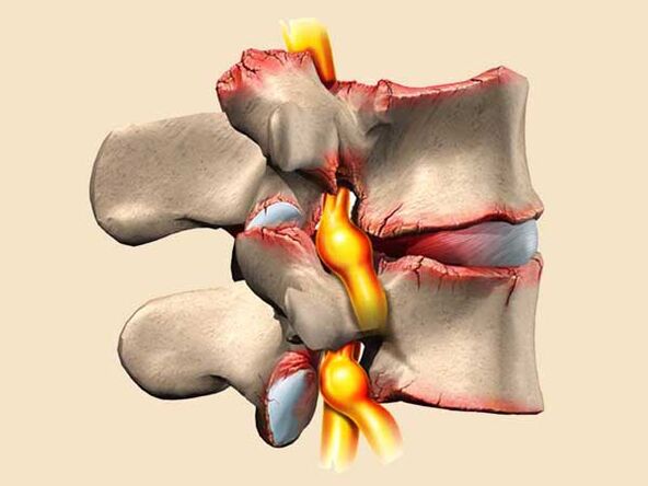 poškodbe hrbtenice pri torakalni osteohondrozi