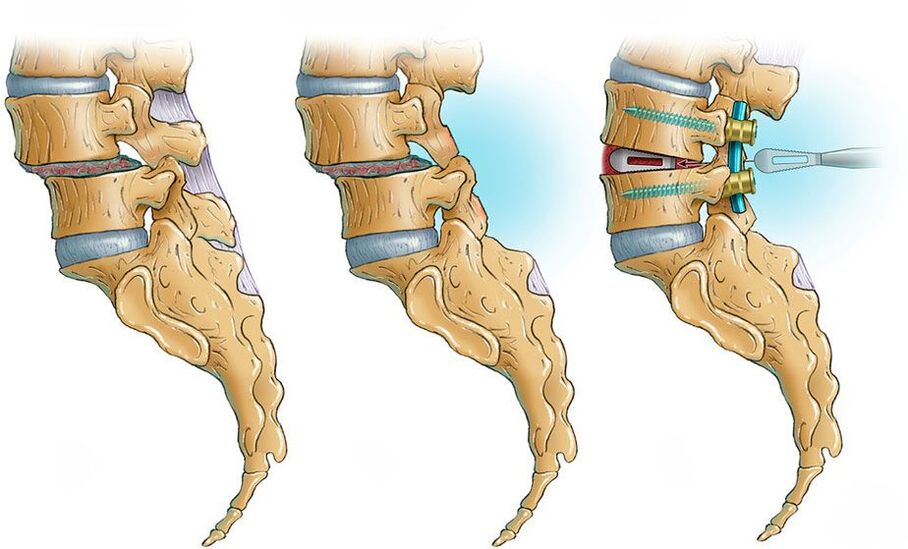 deformacija hrbtenice