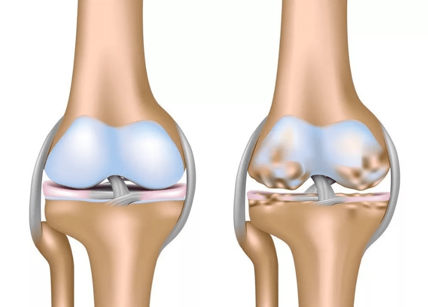 Arthroza