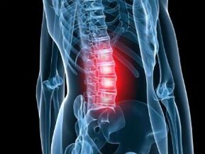 Osteohondroza ledvene hrbtenice