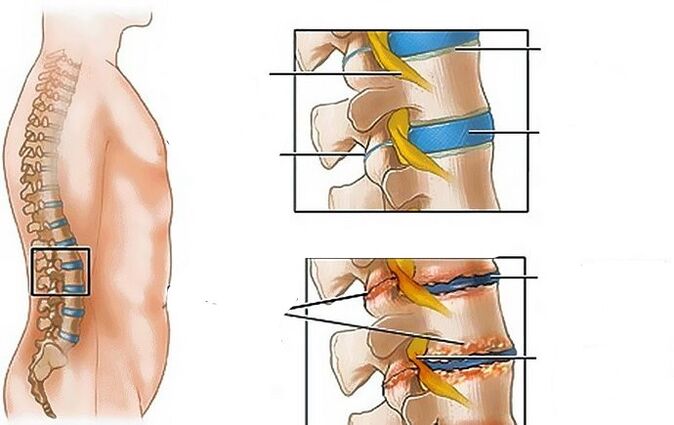 Osteohondroza ledvenega območja