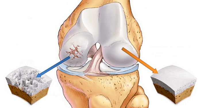 zdrav hrustanec in hrustanec, prizadet zaradi artroze