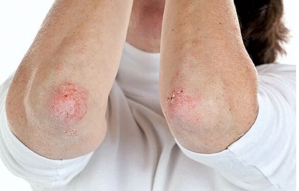 Ljudje s psoriazo so dovzetni za psoriatični artritis