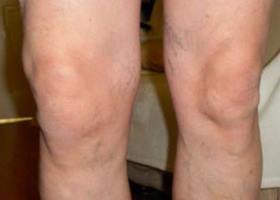 simptomi kolena