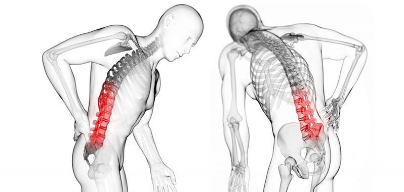zapleti cervikalne osteohondroze