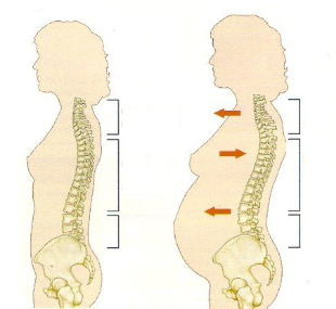 osteohondroza med nosečnostjo