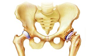 zakaj pride do artroze kolčnega sklepa