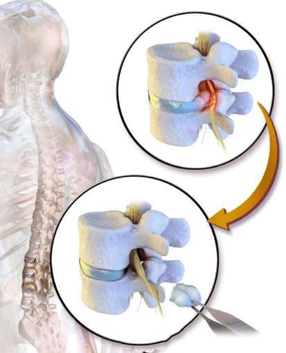 discektomija za bolečine v hrbtu
